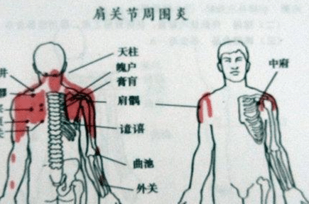 在现代医学中，冻结肩与肩周炎究竟有怎样的区别？